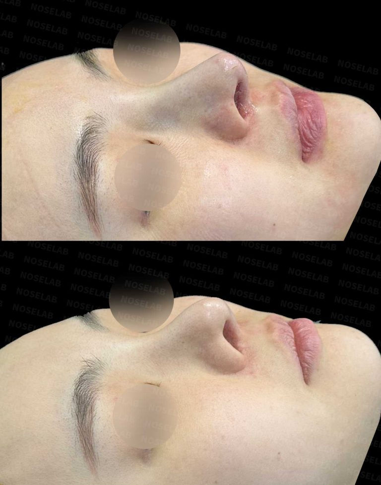 Right 45-degree lateral view before and after Mild Contracted and Upturned Nose Correction – Closed Rhinoplasty Korea