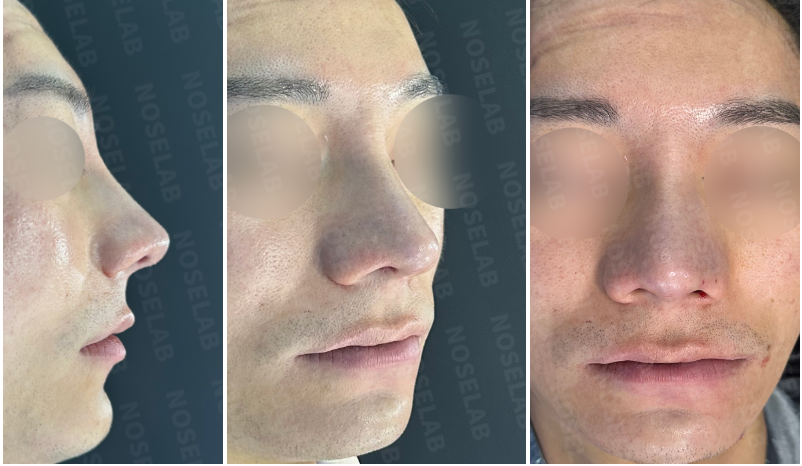 Photos after the surgery. 90° angle | 45° angle | Frontal view