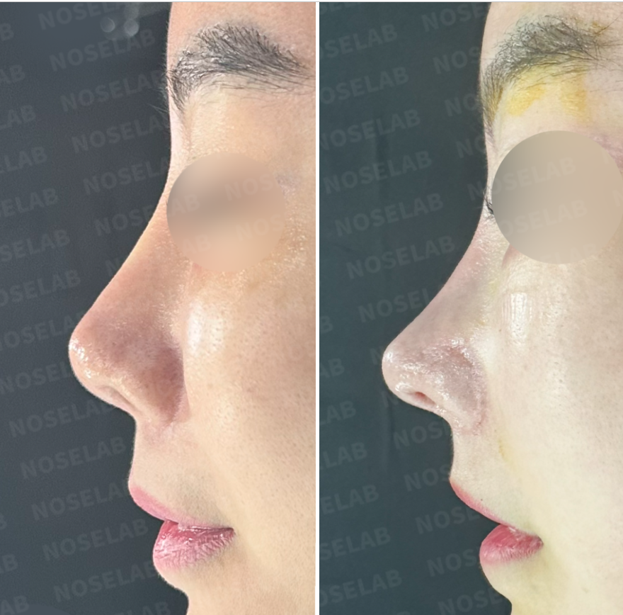 Repeated Dermal Absorption Nose Revision – Before (Left) and Immediately After Surgery (Right) Side View