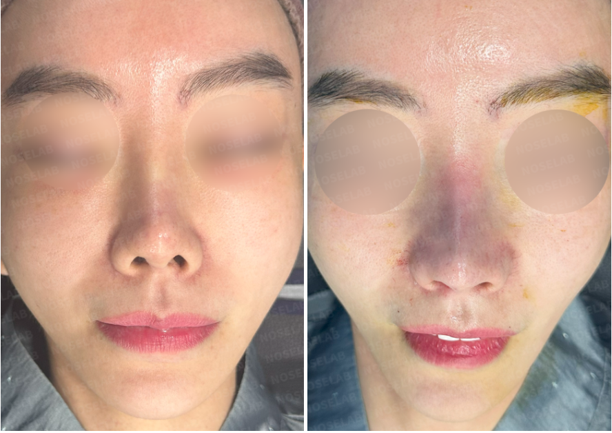 Repeated Dermal Absorption Nose Revision – Before (Left) and Immediately After Surgery (Right) Frontal View