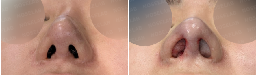 Before and immediately after nostril view of reconstruction following excessive nostril reduction with rib cartilage graft and closed rhinoplasty, showing improved symmetry
