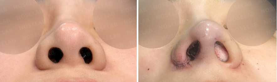 Post-Orthognathic Septal Reconstruction nostril view – before and immediately after closed rhinoplasty revision showing corrected nostril asymmetry and reconstructed septum