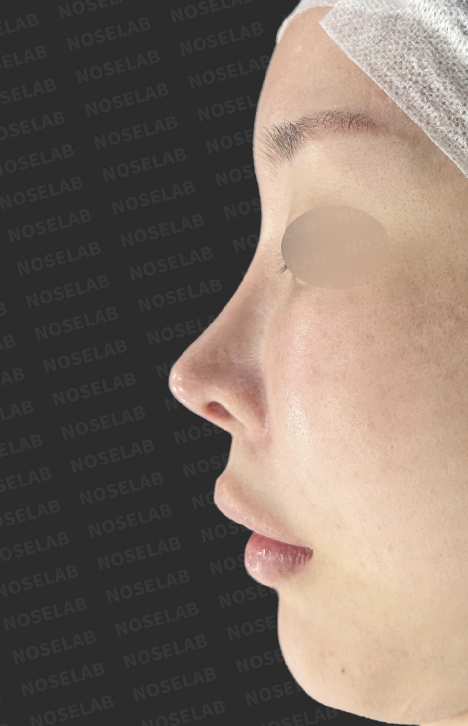 Before surgery: left profile.