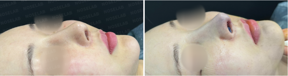 Before surgery (left), after surgery (right) Seen from the oblique angle, we can appreciate the different angle of the starting point and the nasal bridge.
