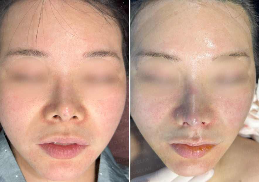 Before and after comparison – frontal view of a patient before surgery (left) and immediate results after Revision Rhinoplasty Korea with closed approach (right), showing reduced nostril exposure, refined nasal tip, and straightened bridge.