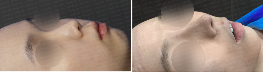 Short nose rhinoplasty – before and after comparison oblique 45-degree view (left before, right after)