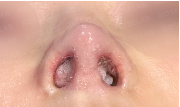 Immediately after customized rhinoplasty for cartilage visibility – nostril view showing corrected cartilage protrusion, improved nostril symmetry, and thicker tip skin for natural coverage.