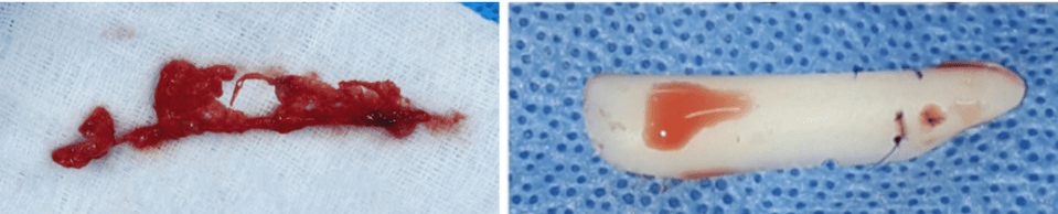 Foreign body (left) and silicone implant (right) removed during surgery.