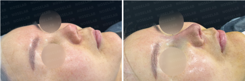 Before surgery (left), after surgery (right)