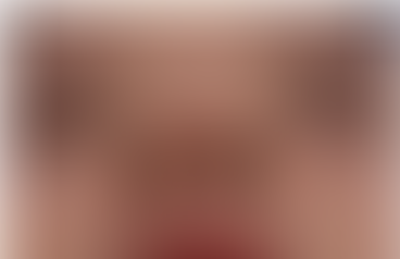 Pre-stem cell treatment nostril view showing nasal contracture and nostril asymmetry prior to reconstructive rhinoplasty.