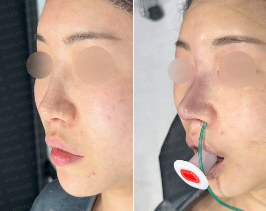 Oblique side view comparison before and after bulbous tip correction using autologous rib cartilage. The right photo shows the immediate postoperative state with nasal airway support.