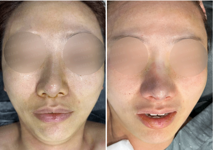 Frontal view before and immediately after revision rhinoplasty showing correction of nasal deviation, improved tip symmetry, and enhanced overall nasal balance
