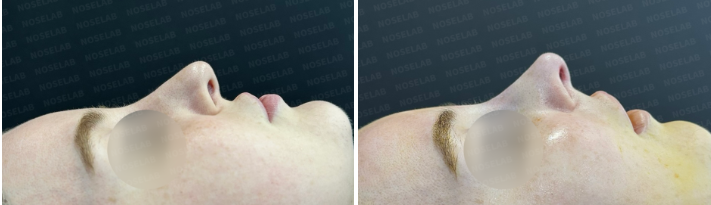Side profile view before surgery (left) after surgery (right)