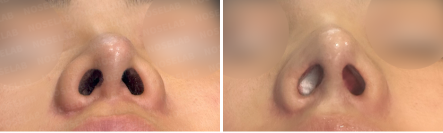 Before and immediately after droopy nasal tip correction, base view showing improved nostril symmetry, refined columella alignment, and balanced nasal base.