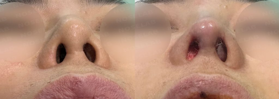 Nostril view before and after Contracted Nose Correction using autologous rib cartilage