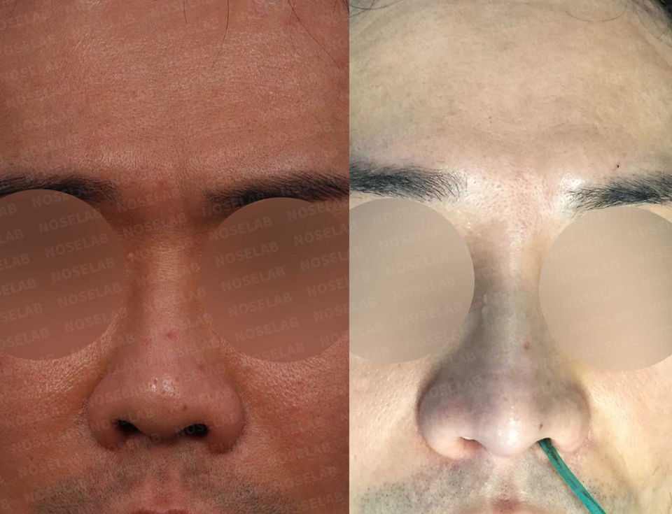 Frontal before and after view showing restored facial balance and nostril symmetry after Upturned Nose and Asymmetric Nostrils Correction – Closed Rhinoplasty Korea