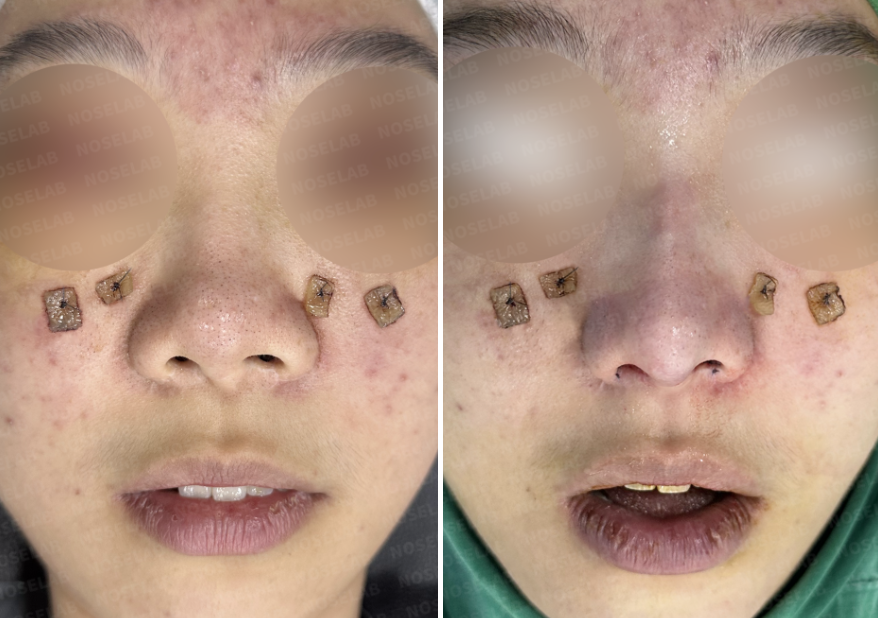 Frontal view before and after surgery showing correction of nasal deviation and improved nostril symmetry after septal reconstruction with rib cartilage.