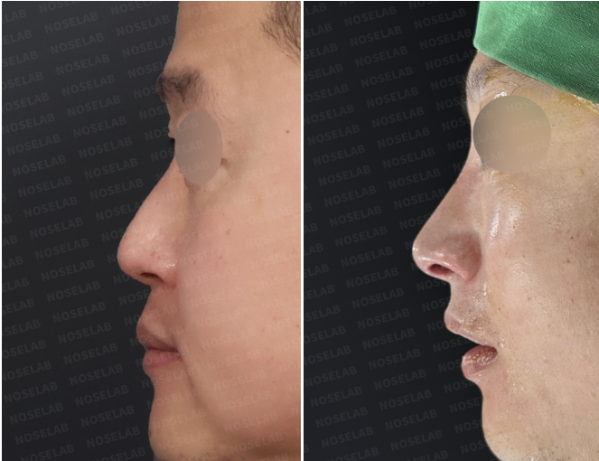 Side before and immediately after views showing conservative nasolabial angle correction after functional rhinoplasty.