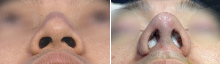Nostril base view comparison before and after dorsal hump correction and septal reconstruction – improved nostril symmetry and internal nasal structure.