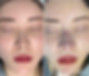 Frontal view comparison before (left) and immediately after surgery (right), showing improved nasal tip alignment and nostril balance.
