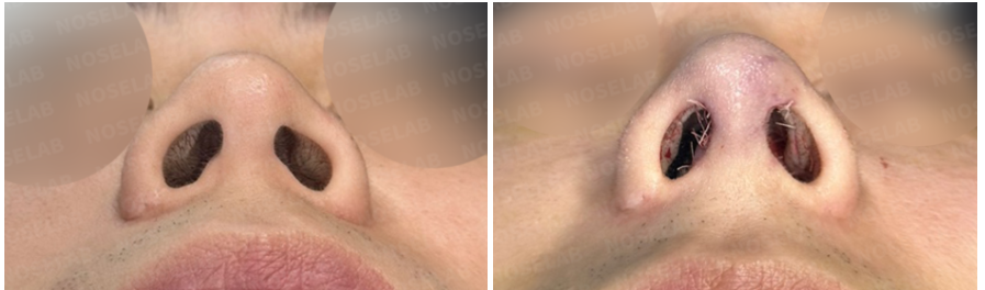 Nostril base view before and after male rhinoplasty Korea: improved nostril symmetry and balanced columella