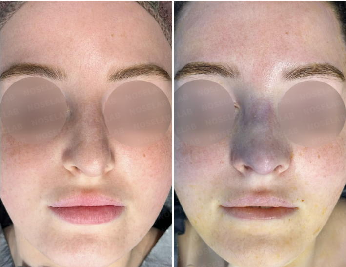 Frontal view before surgery (left) after surgery (right)