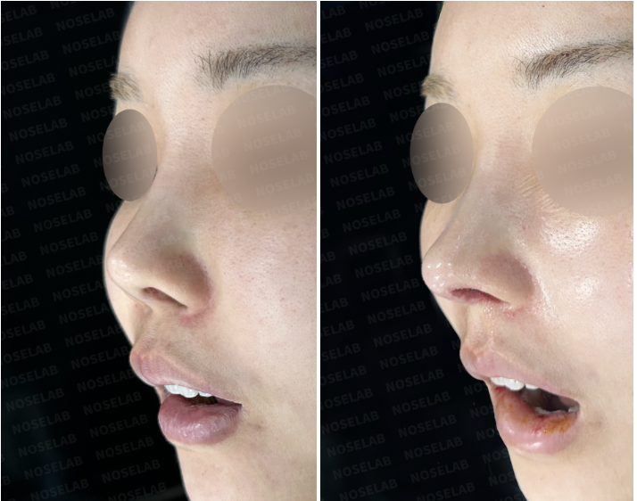 Before and immediately after comparison showing structural improvement after revision rhinoplasty for a short upturned nose.