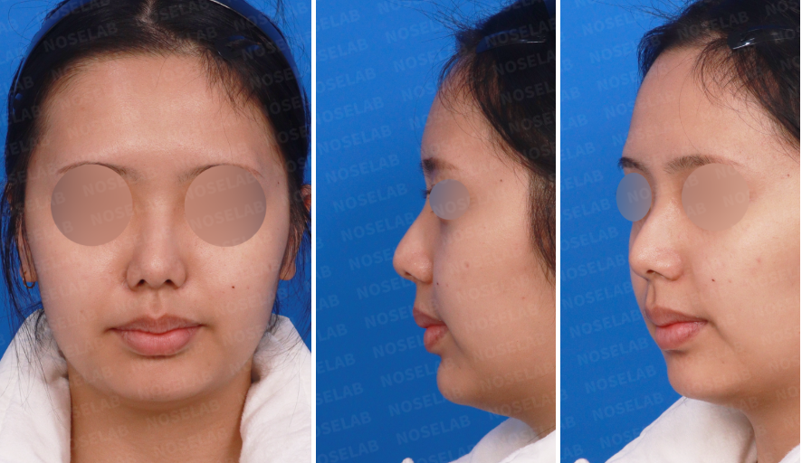 Crooked hump nose correction Korea showing preoperative frontal and oblique views