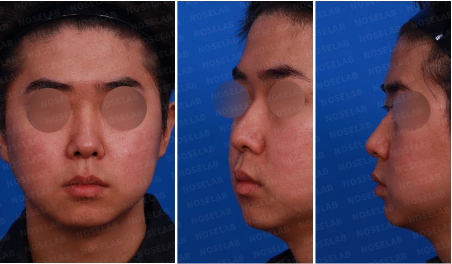Preoperative design consultation photos for short and low nasal bridge rhinoplasty: frontal view, left oblique side view, and left side view.