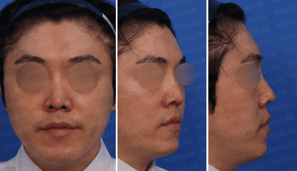 Photos taken for the preoperative design consultation. Frontal view, 45-degree angle vie, and lateral profile view.