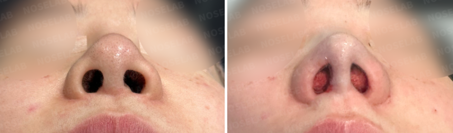 Before and immediately after droopy nasal tip correction – nostril view showing improved symmetry and nasal base shape.