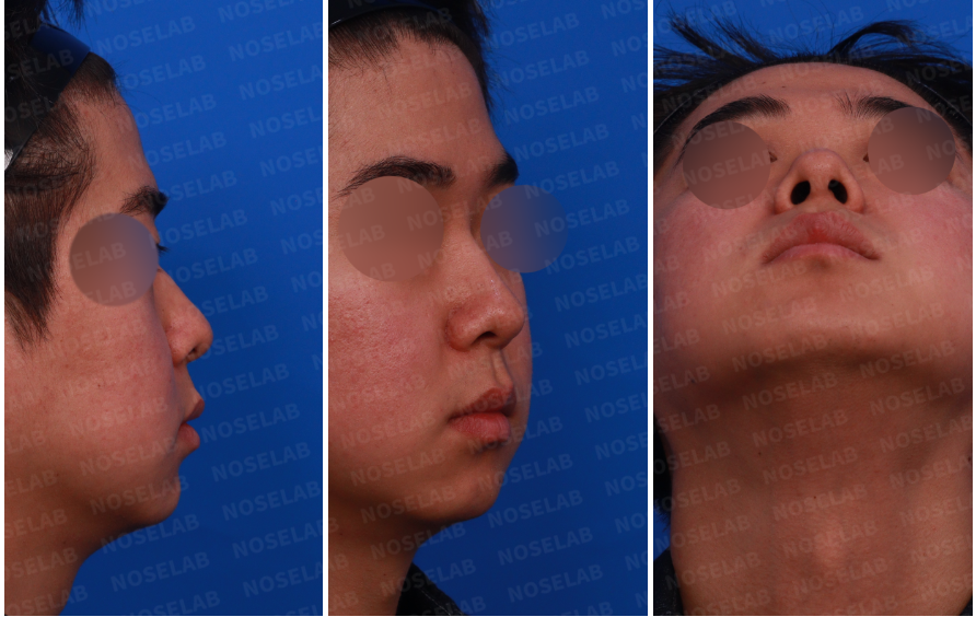 oblique side view, and basal nostril view showing low nasal bridge and wide nostrils.