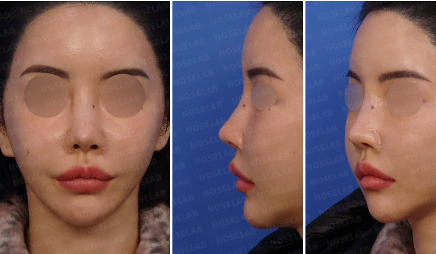 Preoperative design consultation images showing frontal view, left oblique side view, and left lateral view of a patient with nasal deviation and structural deformity following multiple prior rhinoplasty procedures.