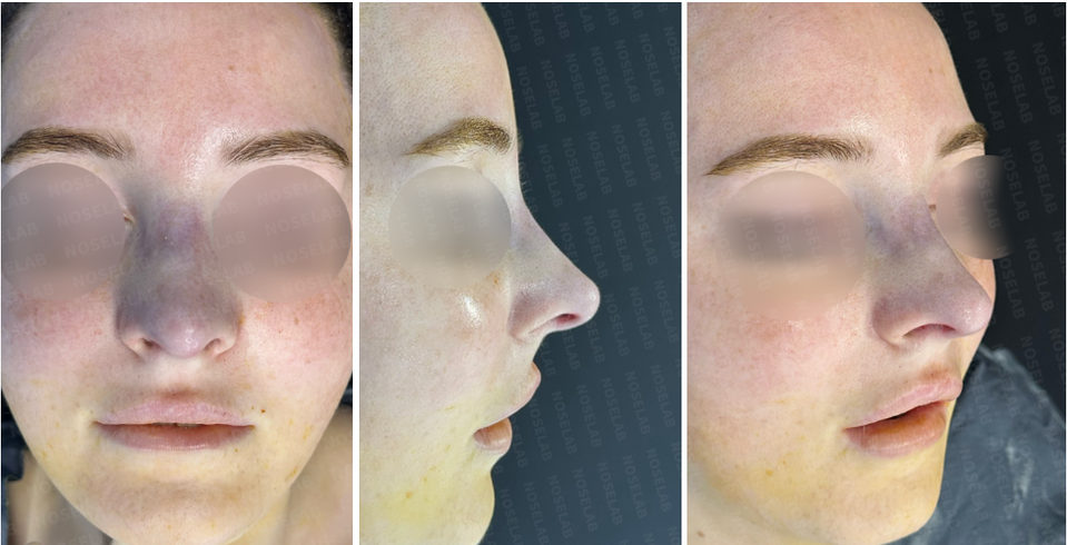 Photos taken immediately after surgery, frontal view, 45-angle view, and side profile.