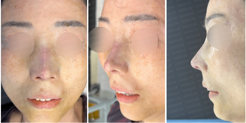 Closed rhinoplasty Korea immediately after surgery – frontal view, right oblique side view, and right side view photos of a patient with corrected crooked nose and nostril asymmetry.