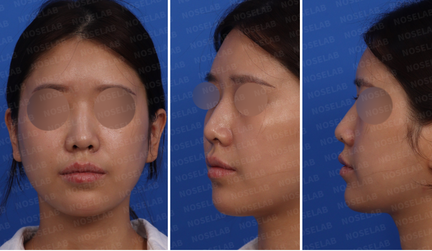 Protruding mouth rhinoplasty – pre-surgery design consultation photos, frontal, left oblique, and side views