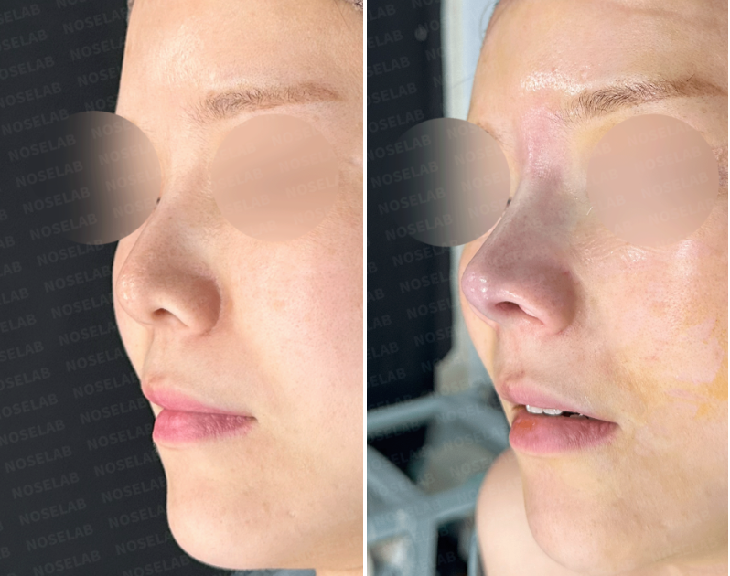 Oblique view comparison before and immediately after revision rhinoplasty: Reshaping of bulbous tip, correction of nasal deviation, and improved nasal projection using minimally calcified rib cartilage.
