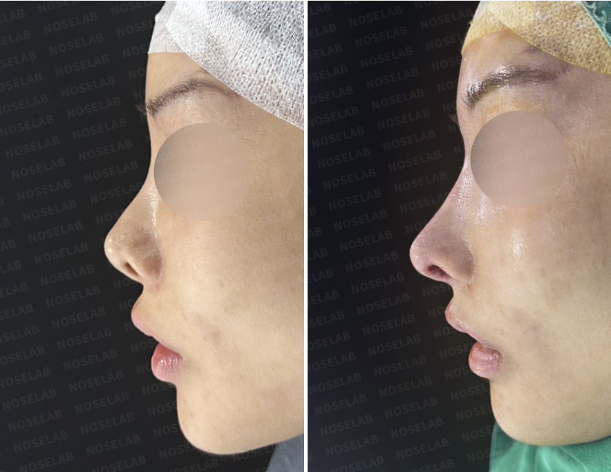 Permanent Filler Removal Rhinoplasty Korea correcting upturned tip and septal damage