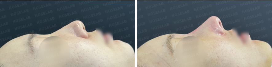 Side profile before surgery (left), After surgery (right)