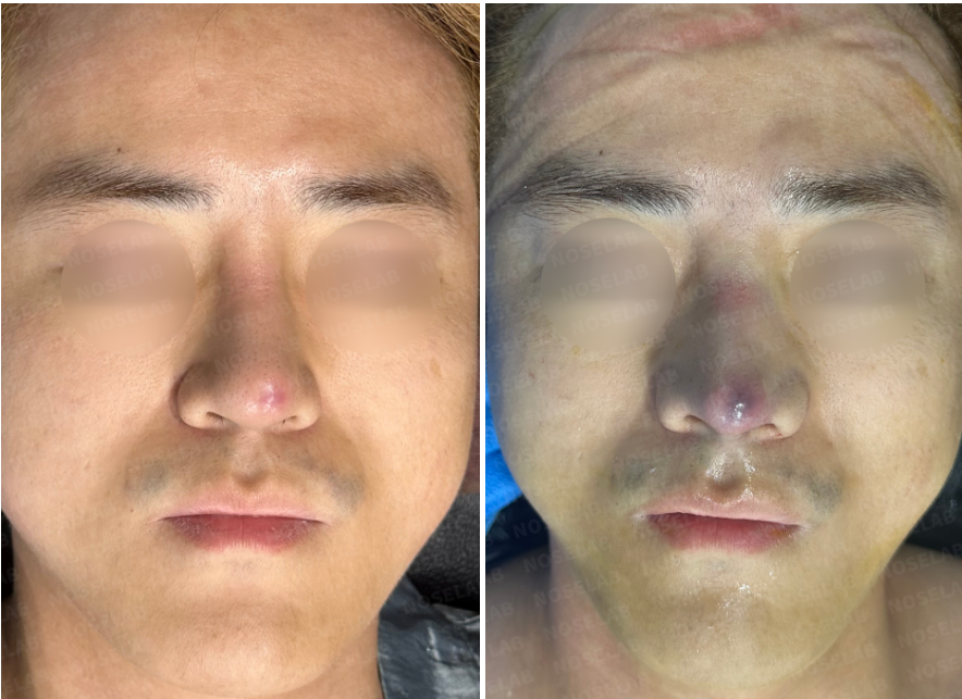 before and after frontal view of silicone exposure rhinoplasty showing reduced inflammation, improved nasal symmetry, and stabilized nasal tip after closed rhinoplasty Korea