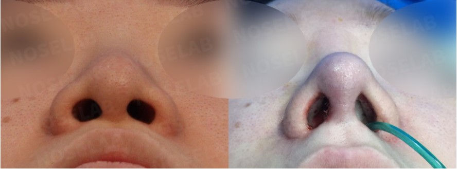 Nostril view before and after Closed Rhinoplasty Seoul – correction of nostril asymmetry and septal deviation using autologous rib cartilage at NoseLab Plastic Surgery.