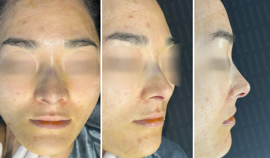 Photos taken immediately after surgery, frontal view, 45-angle view, and side profile.