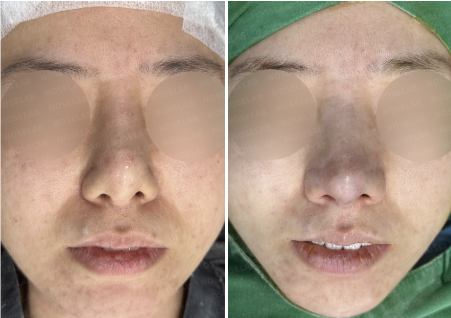 Before and after Contracted Nose Rhinoplasty Korea showing improved symmetry and contour.