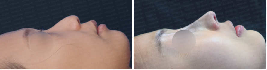 Before and immediately after split nasal tip correction surgery: side view comparison.