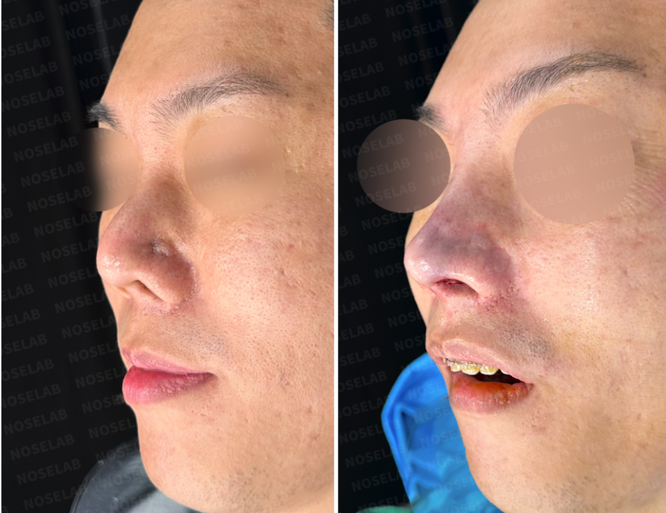 Before and after 45-degree oblique view of nasal contracture reconstruction with rib cartilage graft and closed rhinoplasty
