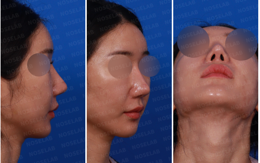 Design consultation photos – right side view, oblique side view, and nostril view for correcting overly reduced alar base in revision rhinoplasty