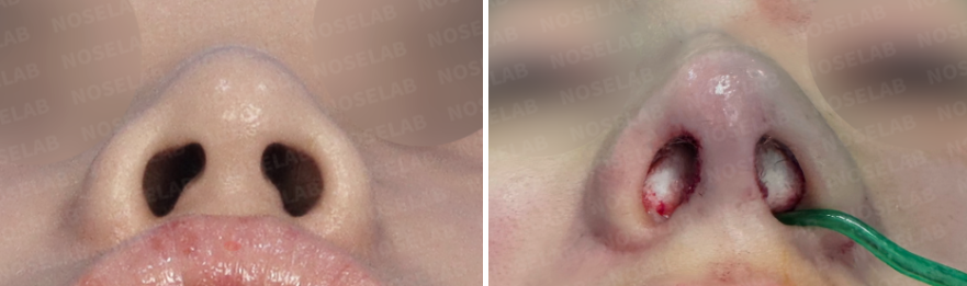 Protruding mouth rhinoplasty – before and after nostril view comparison photos (left: before surgery, right: after surgery)