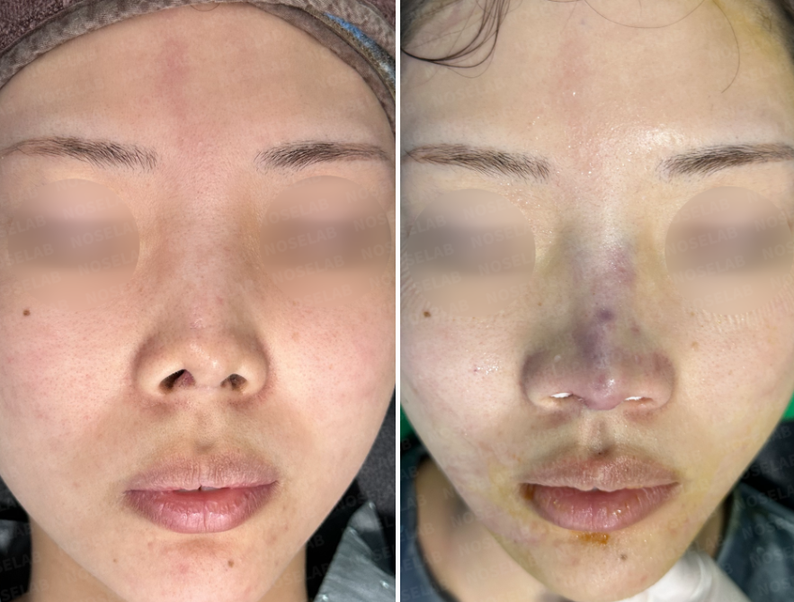 Frontal view before surgery (left), After surgery (right)