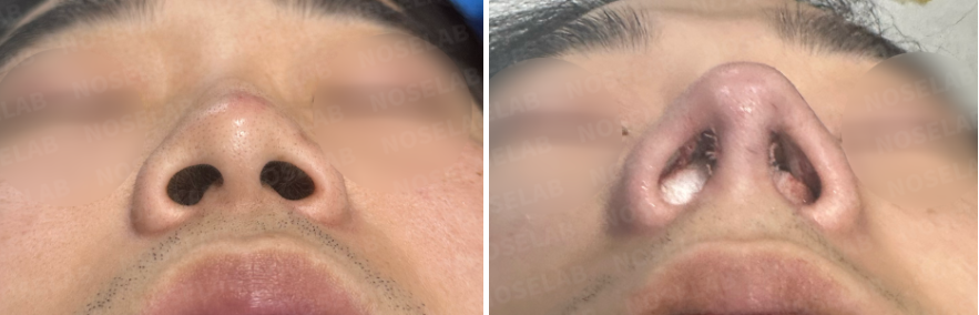 Before and after comparison – nostril view of a short and wide male nose before surgery (left) and immediate results after Male Rhinoplasty Korea with closed rhinoplasty (right), showing improved nostril symmetry and corrected columella position.