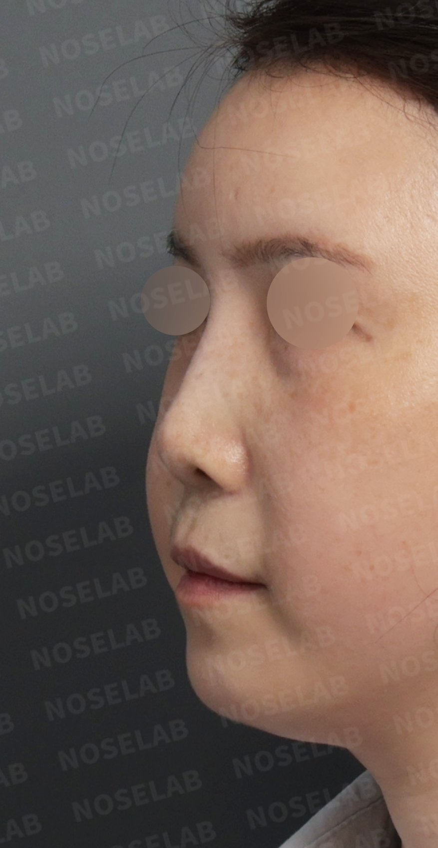 Preoperative consultation: left oblique view.